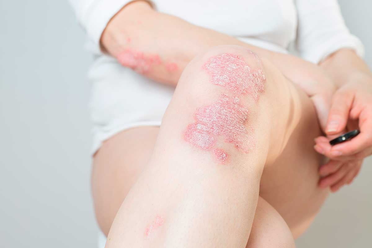 Entendiendo la Psoriasis: Causas, Síntomas y Tratamientos