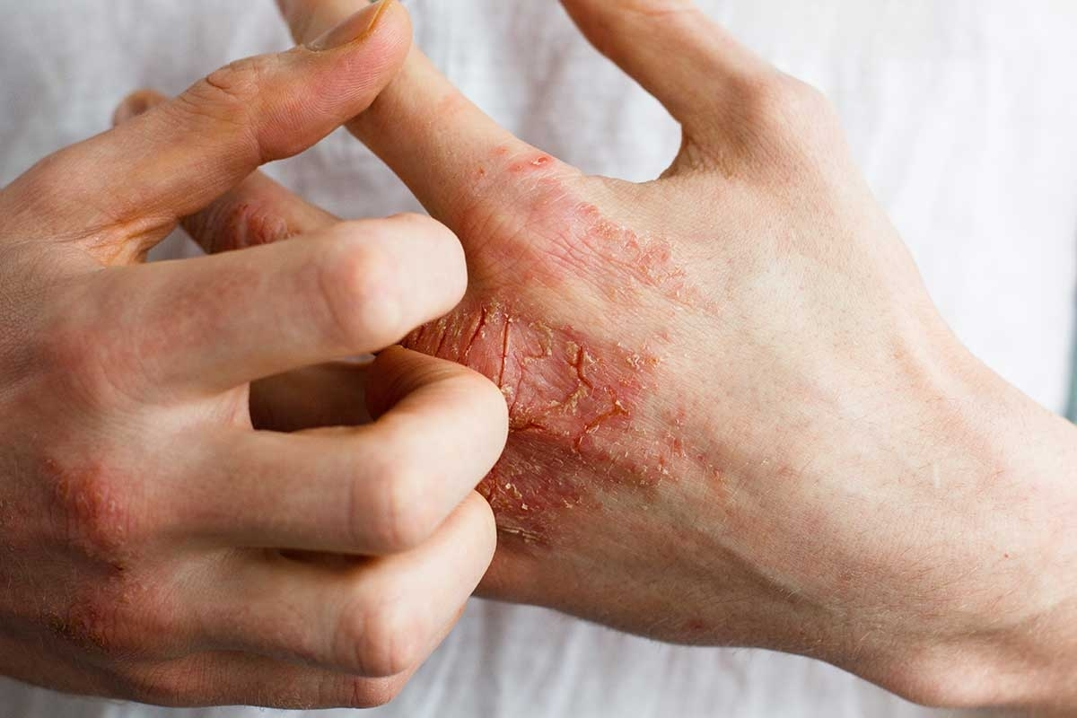 Dermatitis: Comprendiendo la Dermatitis de Contacto y la Dermatitis Atópica