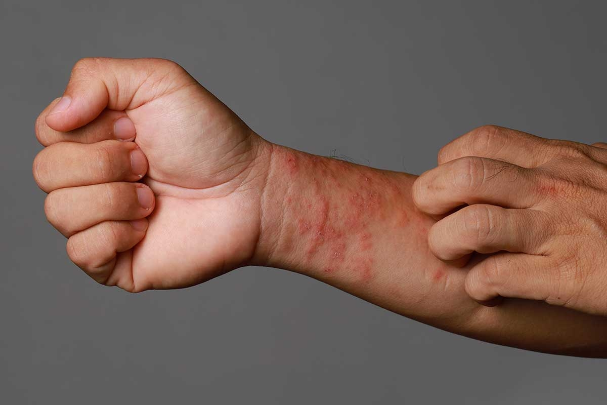 Todo Sobre el Eczema: Síntomas, Causas y Tratamientos Eficaces