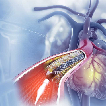 Angioplastia en Badiraguato / Sin