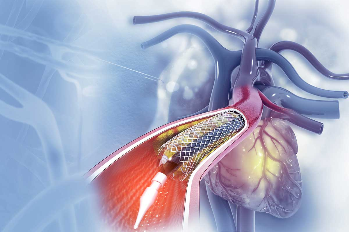 Angioplastia in Badiraguato / Sin